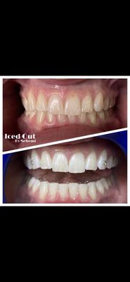 24k gold teeth whitening services - Invest in your smile! 24k gold teeth whitening services - Invest in your smile!