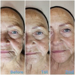 AZ Cryo Sculpt - Cryofacial treatments stimulate the production of collagen and elastin for an anti aging result. Smooh wrinkles, tone and tighten skin.