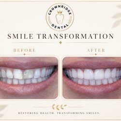San Antonio Dentist - Crownridge Dental - Christian Pham, DMD - Smile Transformation upper crown canine to canine!