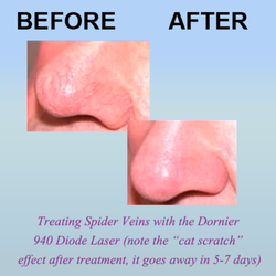 Advanced Laser Aesthetics - Treating spider veins with the Dornier 940 Diode Laser