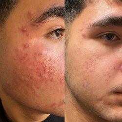 Skin Guru LA - Acné before and after