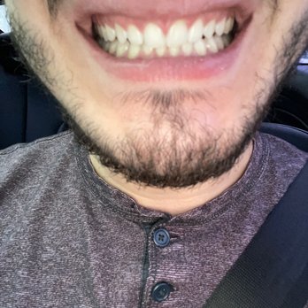 Rassouli DDS - This is a photo of the desired result I reached through Invisalign. - General Dentistry Near Me - Long Beach, California