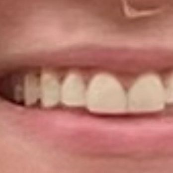 Atrium Dental -Harry H. Elyassi DMD - Old veneers - Teeth Whitening Near Me - Glendale, California