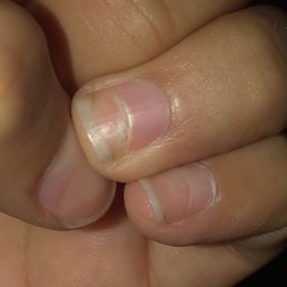 How my nail is now