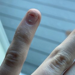 Jazzi's Nail - Damaged nail from drilling