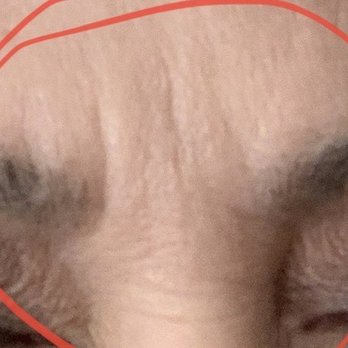 DermaTouch RN - Glabella - Skin Care Near Me - Houston, Texas DermaTouch RN - Glabella - Skin Care Near Me - Houston, Texas