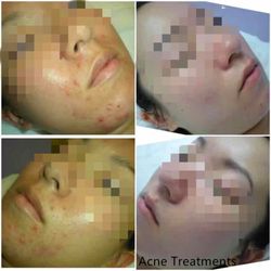 Top 10 Best Skin Tag Removal In West Covina Ca Updated Covid 19 Hours Services Last Updated Yelp