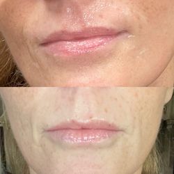 Rejuvena Skin and Wellness Medical Center - Before injection is on top with numbing cream and after is the bottom when I got home.