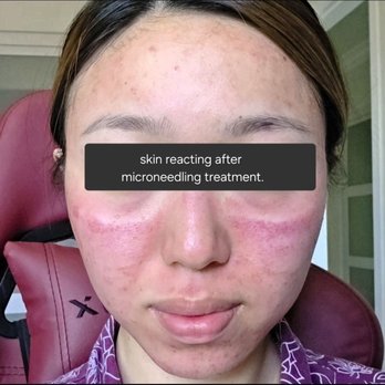 MeSO Medspa - Result after the microneedling treatment. - Medical Spas Near Me - Buena Park, California MeSO Medspa - Result after the microneedling treatment. - Medical Spas Near Me - Buena Park, California