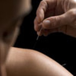 Nuffield Health Wolverhampton Hospital - Acupuncture treatment for shoulder pain