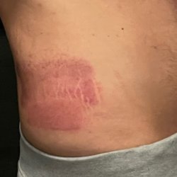 Aqua Spa - January 20th after procedure. Notice that you can clearly tell the handle was repositioned.