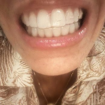 Desert Dream Dentistry & Spa - Clear Correct Aligners with attachments! - General Dentistry Near Me - Palm Desert, California Desert Dream Dentistry & Spa - Clear Correct Aligners with attachments! - General Dentistry Near Me - Palm Desert, California