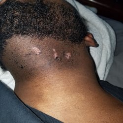Simplicity Laser Hair Removal - 2nd degree burns