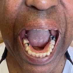 Advanced Dental - I had partials put in on my bottom teeth .