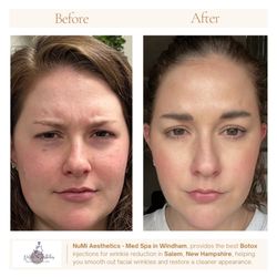 Numi Aesthetics - NuMi Aesthetics provides the best botox injections for wrinkle reduction in Salem, New Hampshire, helping you smooth out facial wrinkles.