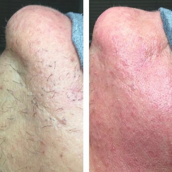 Electrolysis by Chamaine - Chin hair removal. - Hair Removal Near Me - Rogers, Arkansas