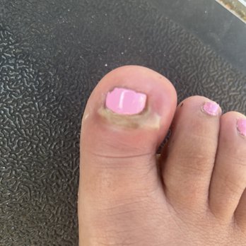 Creative Nails - Bacterial infection from pedicure - Nail Salons Near Me - Port Saint Lucie, Florida