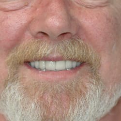 Precision Arts Dental Associates - These are his own teeth restored with crowns. Have been in function for approximately 10 yrs. ( Dr. Sullivan )