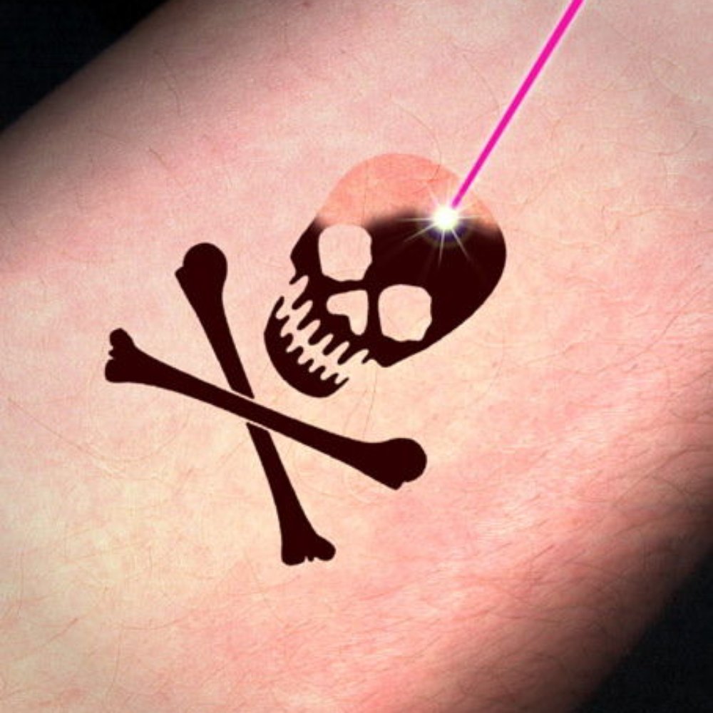 Devon Laser Tattoo Removal Clinic UK - Free Consultations in Plainmoor Torquay - Medical Spas Near Me - Torquay, TOB Devon Laser Tattoo Removal Clinic UK - Free Consultations in Plainmoor Torquay - Medical Spas Near Me - Torquay, TOB