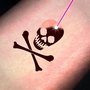 Photo of Devon Laser Tattoo Removal Clinic UK