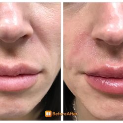 Montville Medspa & Pain Center - Montville MedSpa & Pain Center Fillers
