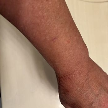 Number 1 Buffet - Swelling on arm - Buffets Near Me - Avondale, Arizona