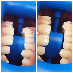 Ba'yoami Beauty Parlour & Spa - Laser Teeth Whitening 1 Session