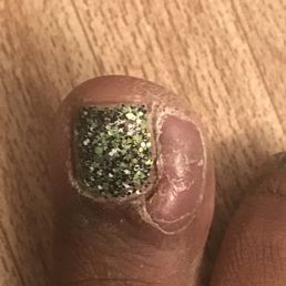 After popping and peeling the skin. After popping and peeling the skin.