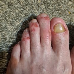Technician used a pummel stone on top of toes, extreme discomfort,CAUTION AND DANGER