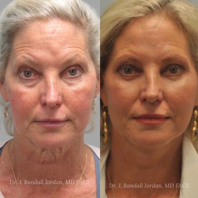 Face Lift - Cosmetic surgery is a deeply personal choice, and people contact our practice for many different reasons. At Faces, we begin every facial plastic surgery experience with an educational consultation that aims to fulfill your desires and formulate the most effective treatment plan for your objectives.

What Are the Benefits of Undergoing a Facelift?
Genetics, lifestyle factors, and time all play a part in making people look older. Even the sun, the source of all life on the planet, is part of the reason we start seeing the lines and contours that can make us feel much older than we are. There’s no escaping the subtle and sometimes not-so-subtle signs of aging, but there are many ways to use plastic surgery procedures, such as the facelift, to control and even restore your natural beauty.

Choosing to have a facelift procedure is a deeply personal decision, unique to each person. Of course, the benefits you'll receive from a facelift will depend on your long-term aesthetic goals, but generally speaking, these benefits include:

A greater sense of self-confidence
Reduced signs of facial aging 
More natural, youthful facial contours
A less tired appearance
Smoother-looking skin on the face
A more attractive jaw line and neck contour


Dr. Jordan can combine a facelift with other facial plastic surgery procedures, such as blepharoplasty (eyelid surgery) and a brow or forehead lift, to achieve even more dramatic results. During your consultation at Faces, our facial plastic surgery team will develop a treatment plan specifically designed to improve your facial aging. Our goal is to guide you and help you get the most from your facelift and cosmetic surgery experience.