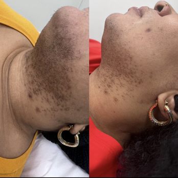 Desire Laser Plus - After just one session - Laser Hair Removal Near Me - Huntington Station, New York Desire Laser Plus - After just one session - Laser Hair Removal Near Me - Huntington Station, New York