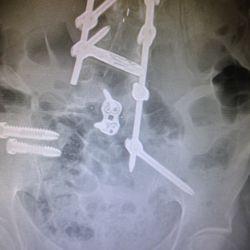Joseph R O'Brien, MD - Failed lumbar fusion