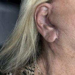 Boston Facial Plastic Surgery - Brushing around ear 2weeks after unable to chew food.