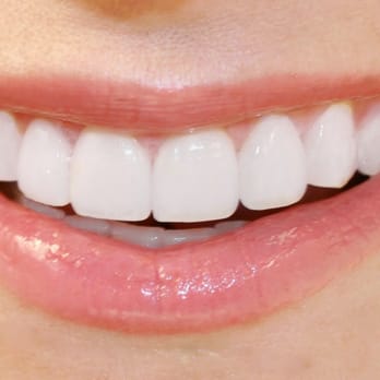 Dentures Sarasota - General Dentistry Near Me - Sarasota, Florida Dentures Sarasota - General Dentistry Near Me - Sarasota, Florida