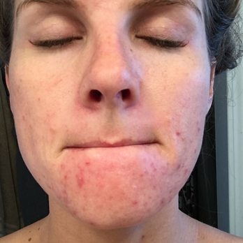 Davis Dermatology - Before treatment ( my acne wasn't even that bad here compared to other breakouts) - Medical Spas Near Me - Davis, California Davis Dermatology - Before treatment ( my acne wasn't even that bad here compared to other breakouts) - Medical Spas Near Me - Davis, California