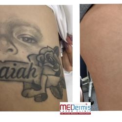 MEDermis Tattoo Removal  - Full removal after 5 treatments with  MEDermis Tattoo Removal