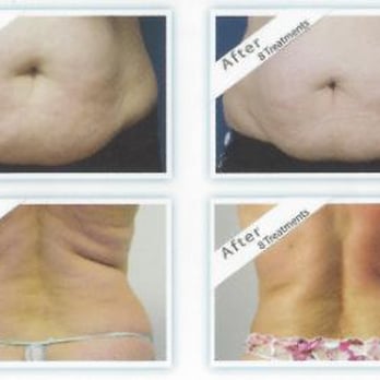 Facial Finesse - Venus Freeze Skin Tightening - Skin Care Near Me - San Antonio, Texas Facial Finesse - Venus Freeze Skin Tightening - Skin Care Near Me - San Antonio, Texas