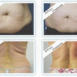 Facial Finesse - Venus Freeze Skin Tightening