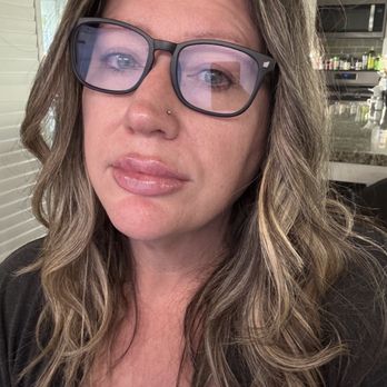 NAKEDMD - Rancho Cucamonga - Lips the morning after - Medical Spas Near Me - Rancho Cucamonga, California