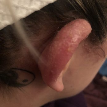 Denton Color Lab - Chemical burns - Hair Extensions Near Me - Denton, Texas