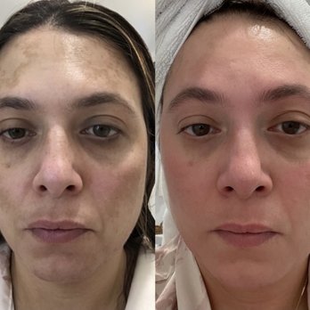 MedSkinEssentials - Cosmelan peel - Medical Spas Near Me - Tustin, California MedSkinEssentials - Cosmelan peel - Medical Spas Near Me - Tustin, California