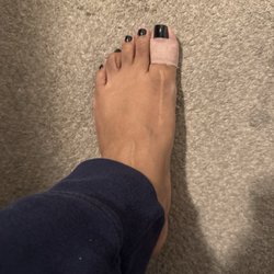 Left with missing skin & bleeding