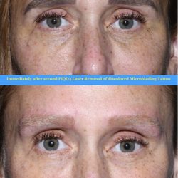 James Goodnight, MD - Everlasting Beauty - Laser tattoo removal eyebrow tattoo