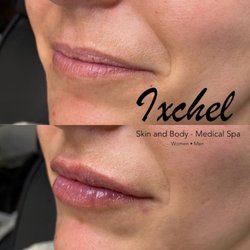 Ixchel Skin and Body Medical Spa - Lip Augmentation with Restylane Kysse