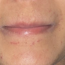These are the scratches on my chin and lip area caused by the threading this week. These are the scratches on my chin and lip area caused by the threading this week.