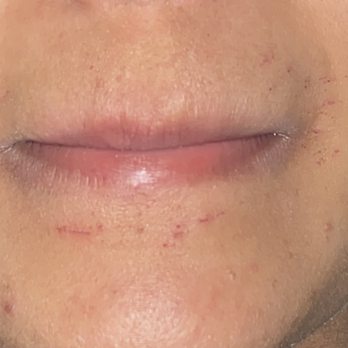 Brow Wow - These are the scratches on my chin and lip area caused by the threading this week. - Threading Services Near Me - Austin, Texas Brow Wow - These are the scratches on my chin and lip area caused by the threading this week. - Threading Services Near Me - Austin, Texas