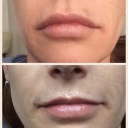 1 syringe of Juvederm Ultra XC injected by Emily (had labret and medusa piercing...scars, not from injections)