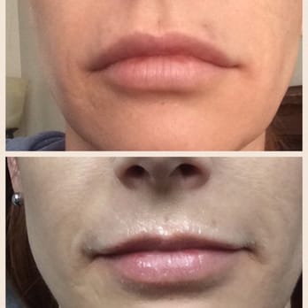 Dr. J. J. Wendel Plastic Surgery - 1 syringe of Juvederm Ultra XC injected by Emily (had labret and medusa piercing...scars, not from injections) - Cosmetic Surgeons Near Me - Nashville, Tennessee