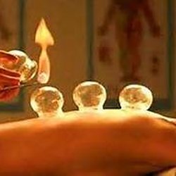 McCormick Acupuncture Center - Fire cupping is a therapy offered at the clinic and very effective for pain and respiratory conditions.