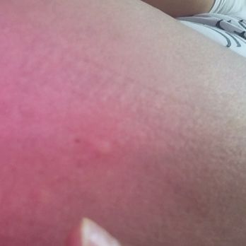 Hyatt Place Dublin/Pleasanton - Bedbug bites on my right back of my legs. - Hotels Near Me - Dublin, California Hyatt Place Dublin/Pleasanton - Bedbug bites on my right back of my legs. - Hotels Near Me - Dublin, California